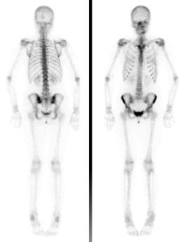 Ganzkörperskelettszintigraphie